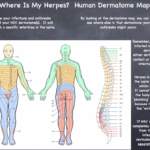 All About HSV Human Dermatome Map