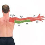 Cervical Dermatome Map Physical Therapy Hand Therapy Massage Therapy