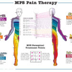Dermatome Poster Large Dolphin Neurostim MPS Therapy