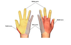 dermatomes neurology medbullets step 1 8 Dermatomes Neurology Medbullets Step 1