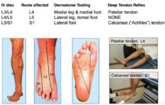 Foot Dermatomes Feet Achilles Deep