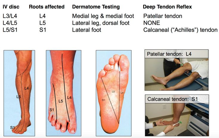 Foot Dermatomes Feet Achilles Deep