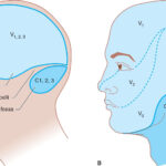 Headache Facial Pain Neupsy Key